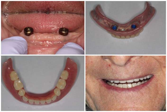 Korean Dentures Butte MT 59750